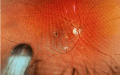 Encelto™ (revakinagene taroretcel-lwey) for Macular Telangiectasia Type 2