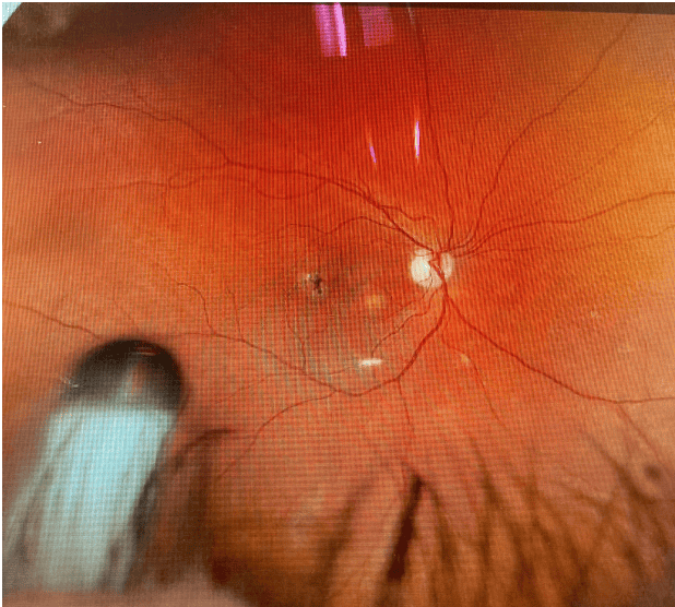 Encelto™ (revakinagene taroretcel-lwey) for Macular Telangiectasia Type 2