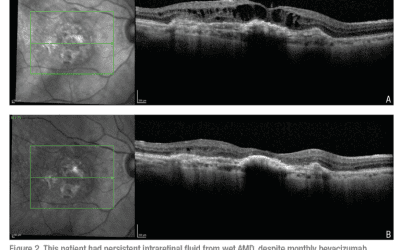 Advances in Wet AMD: Fewer Injections, Longer-Lasting Treatments, and What’s Next