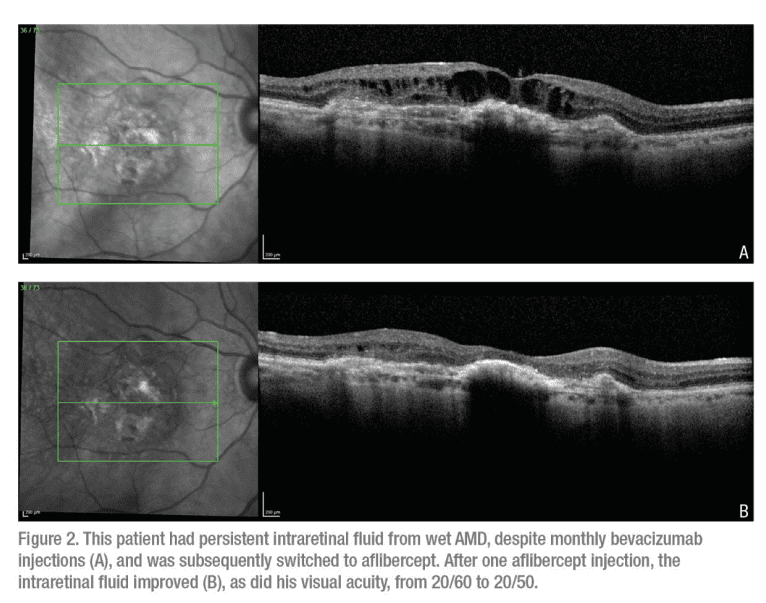 Advances in Wet AMD: Fewer Injections, Longer-Lasting Treatments, and What’s Next